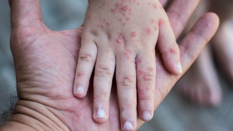 Detectan tres casos de virus Coxsackie en Puebla